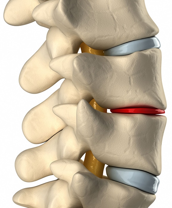 Degenerative Disc Disease Specialists In Schertz BioMotion PT